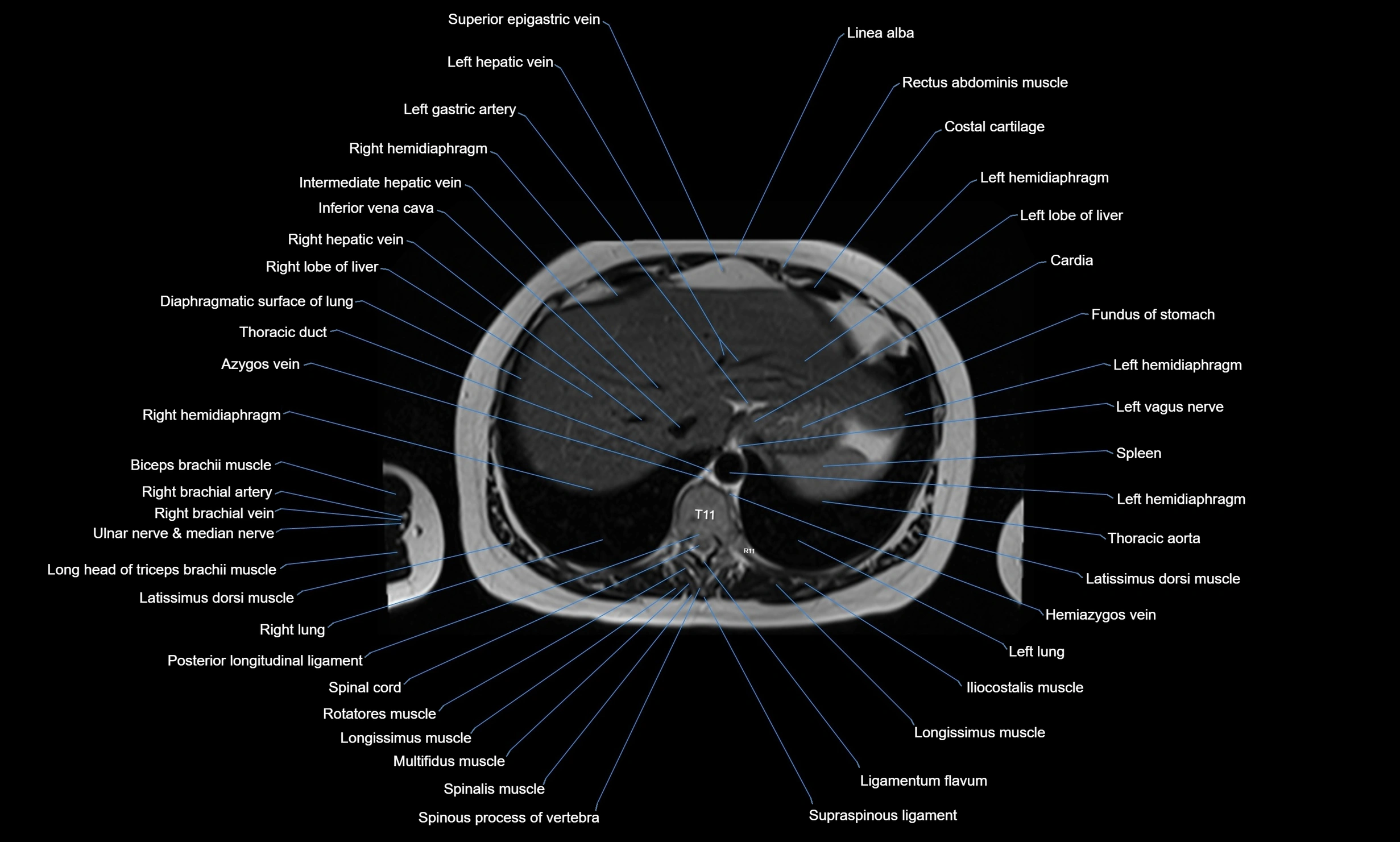 MRI chest axial  cross sectional anatomy 3T radiology  image-img-00001-00038.webp